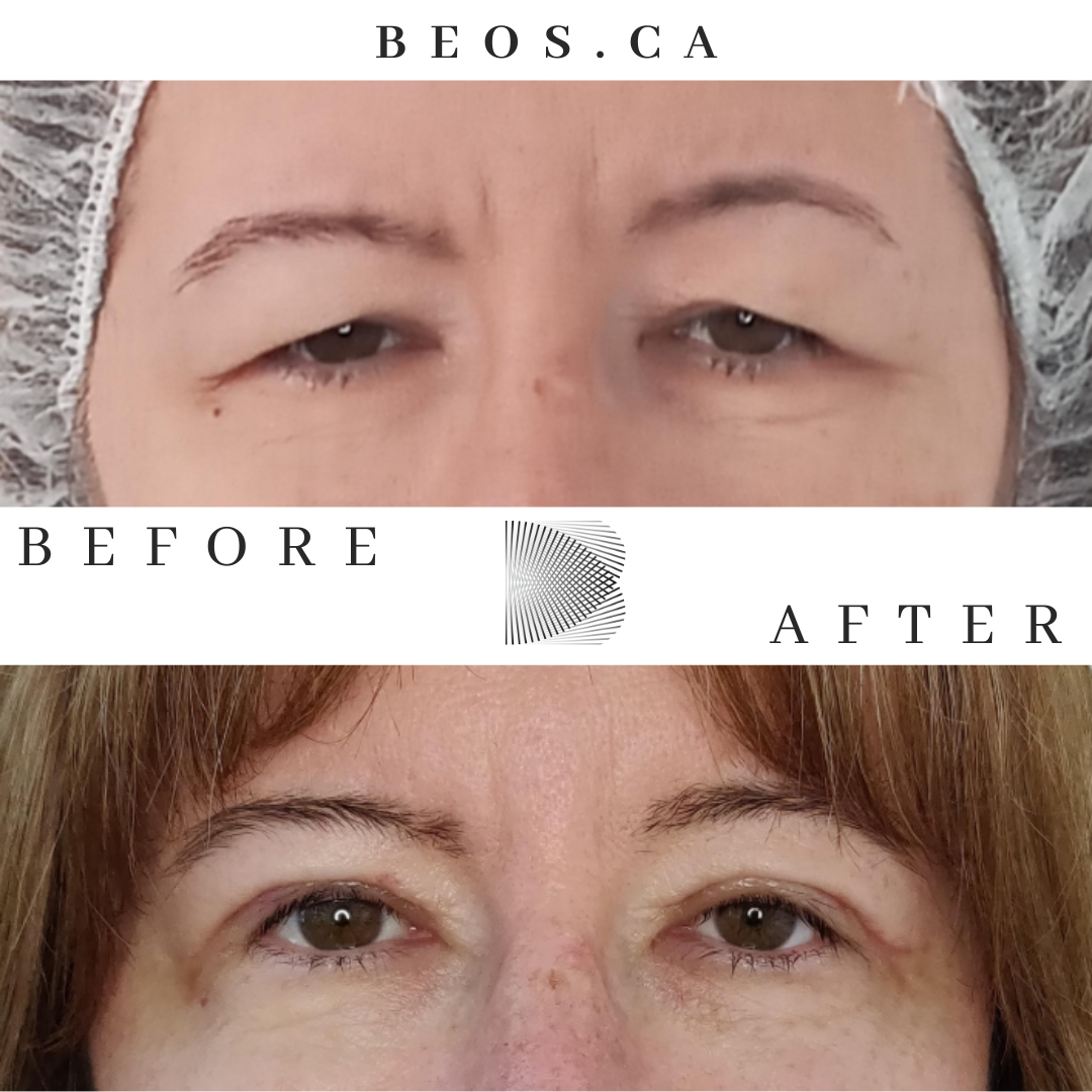 BA01 before and after comparison