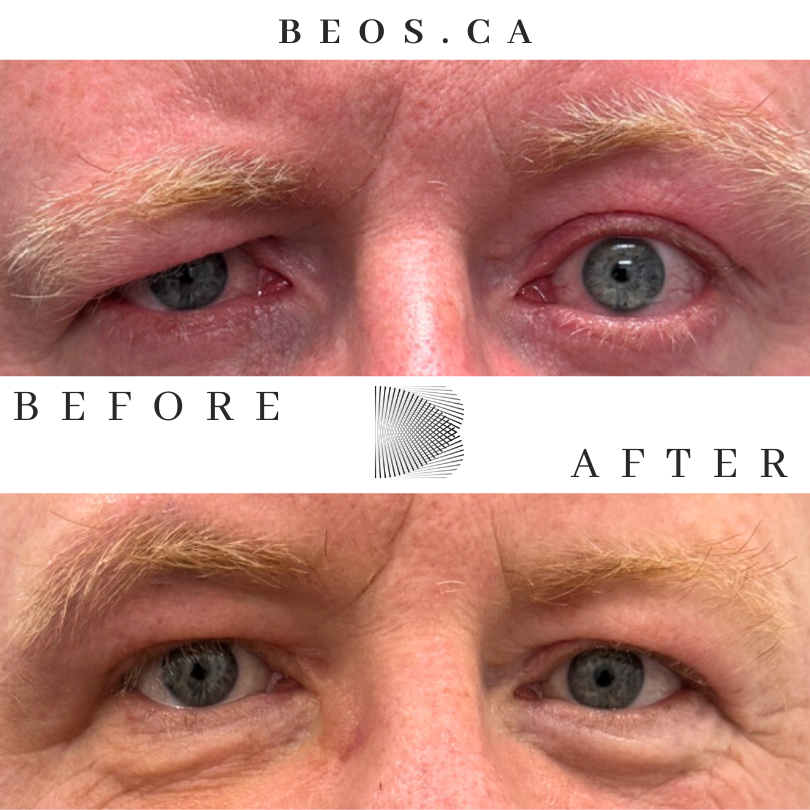 BA02 before and after comparison