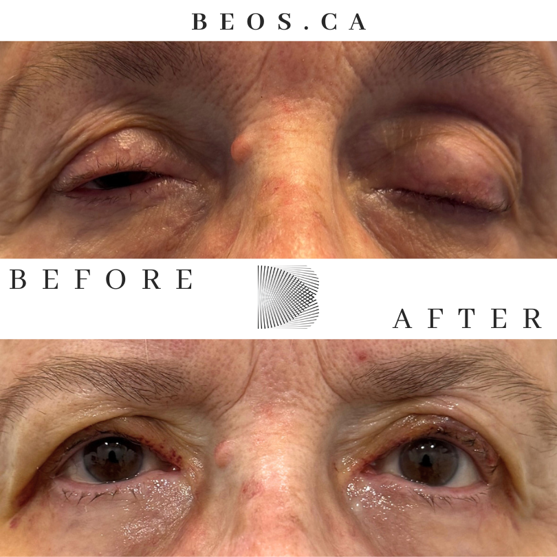 BA04 before and after comparison