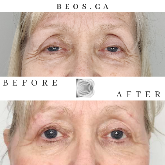 BA05 before and after comparison