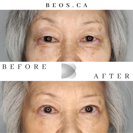 BA07 before and after comparison