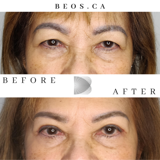 BA09 before and after comparison