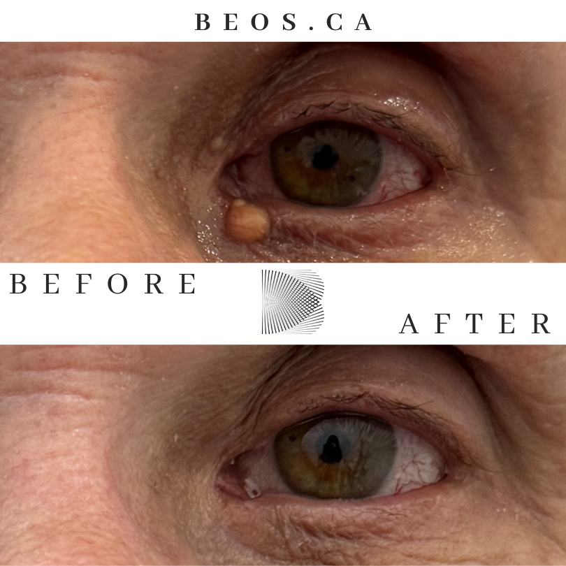 BA10 before and after comparison