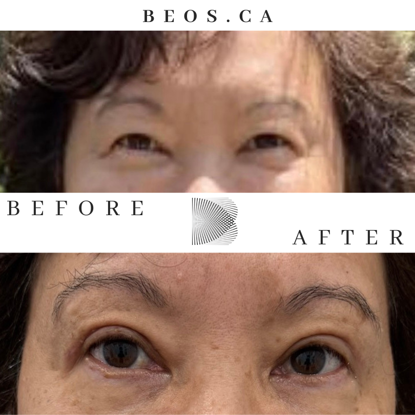 BA12 before and after comparison