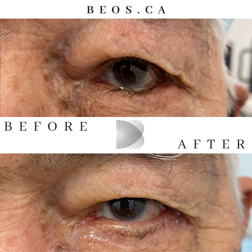 BA15 before and after comparison