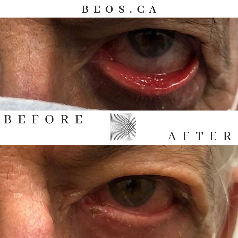 BA16 before and after comparison