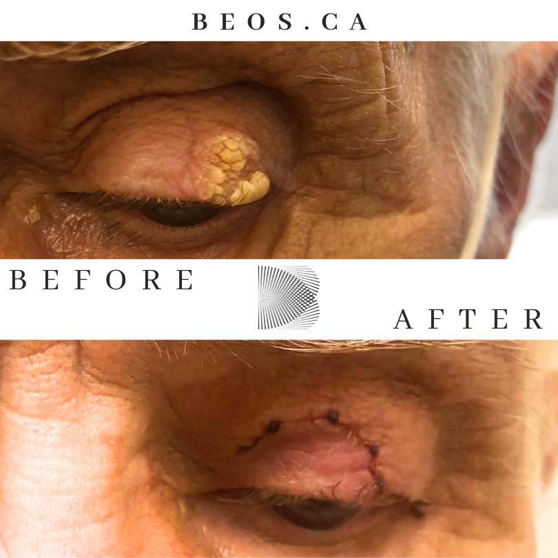 BA17 before and after comparison