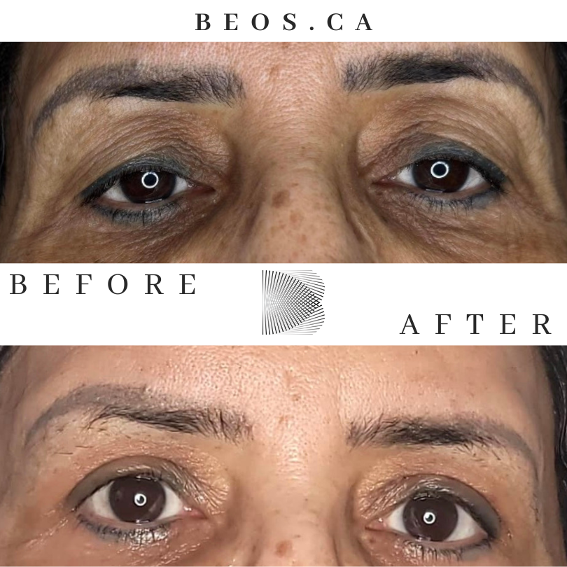 BA19 before and after comparison