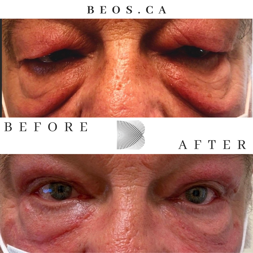 BA20 before and after comparison