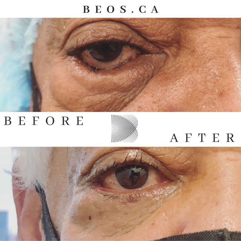 BA21 before and after comparison