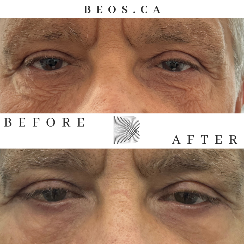 BA22 before and after comparison