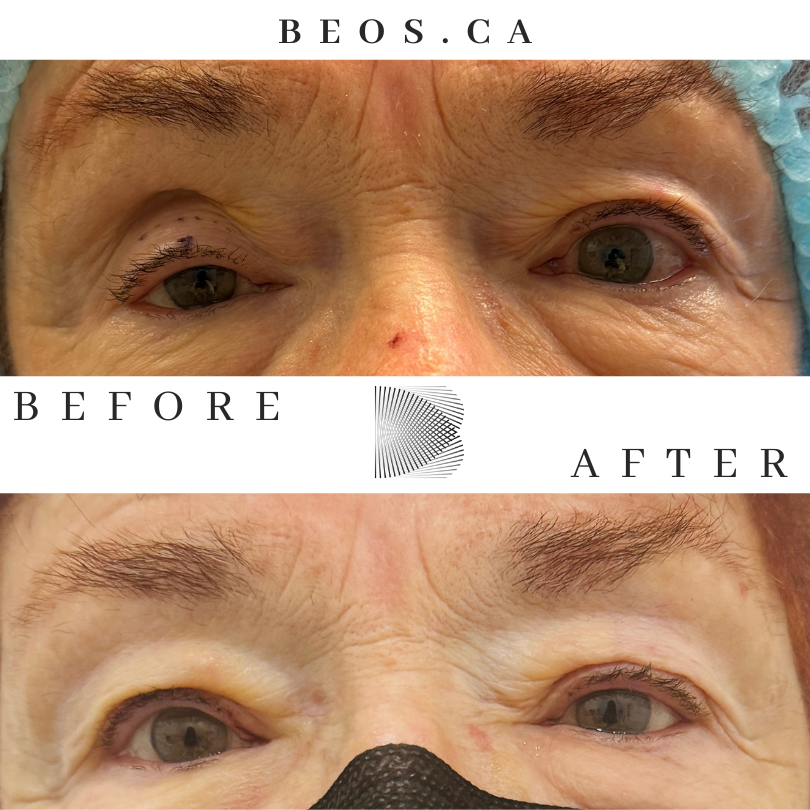 BA24 before and after comparison