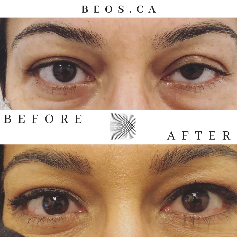 BA25 before and after comparison