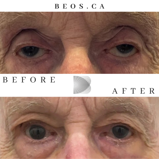 BA27 before and after comparison