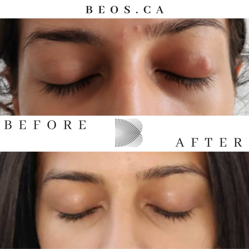 BA28 before and after comparison